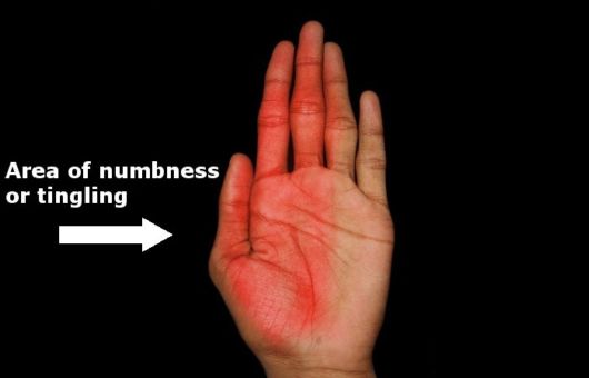 Carpal Tunnel Syndrome - All You Need To Know